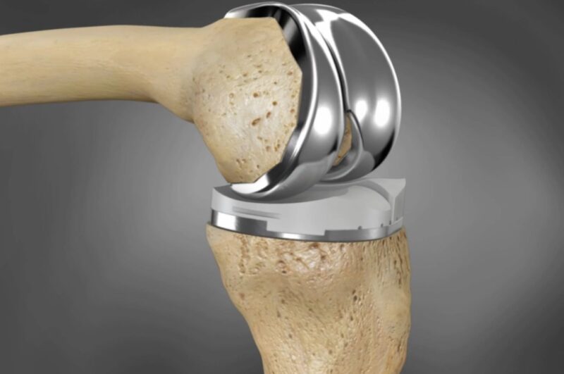 Sélection d'implants pour l'arthroplastie du genou