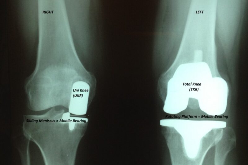 Imagerie avancée avant la chirurgie du genou
