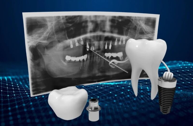 Planification des implants et dentisterie numérique